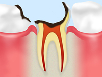 C3神経の虫歯