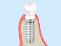 インプラント治療とは