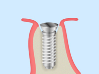 【STEP3】1次手術：インプラント埋入
