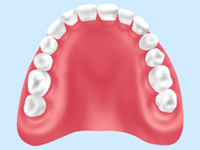レジン床義歯