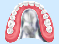 金属床義歯