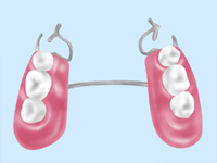 入れ歯・ブリッジ治療
