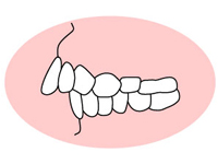 上顎前突 （じょうがくぜんとつ）