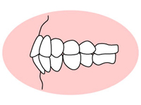 上下顎前突 （じょうげがくぜんとつ）