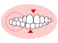 交叉咬合 （こうさこうごう）