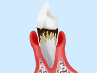 歯周病は、多くの日本人が悩まされている病気です